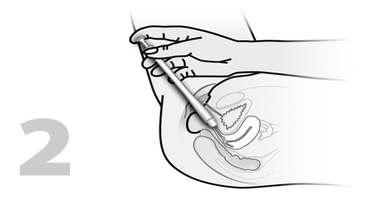 Platzierung der KadeFungin 3 Vaginaltablette
